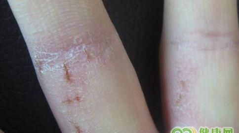手部湿疹的治疗方法有哪些