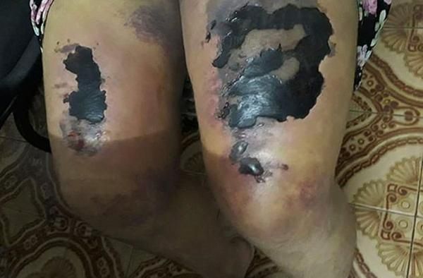 巴西女子被丈夫在黑魔法仪式上殴打大腿坏死