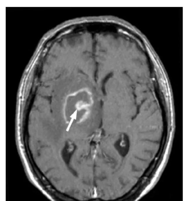 中枢神经系统螺旋体、寄生虫感染，MRI表现看这里